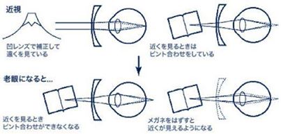 近視の人は老視にならない？