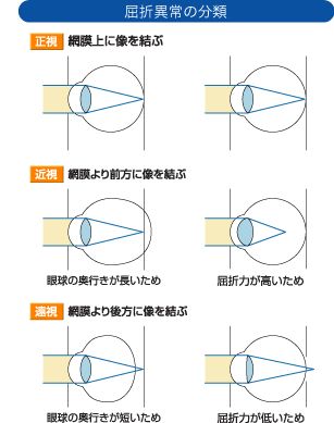 屈折異常の分類