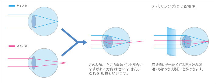 メガネレンズによる補正