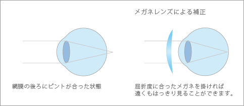 メガネレンズによる補正