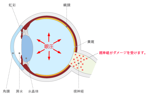 視神経が受けるダメージ