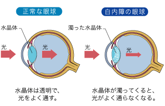 正常な眼球と白内障の眼球の比較